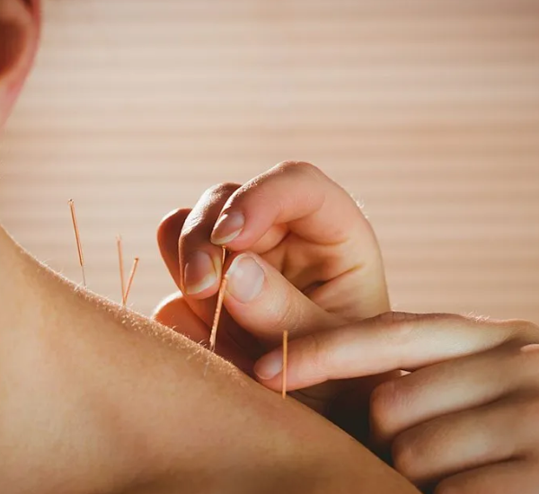 Unlocking the Benefits of Fertility Acupuncture in Sydney