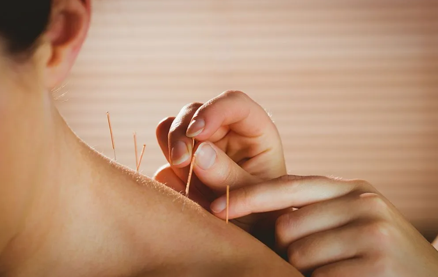 Unlocking the Benefits of Fertility Acupuncture in Sydney
