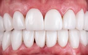 Dental Veneers