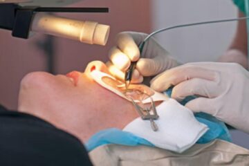 Refractive Surgery