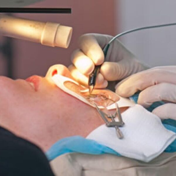 Refractive Surgery